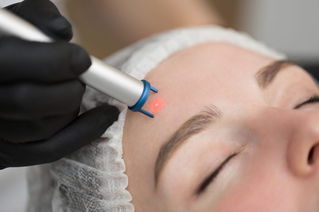 Laser treatment for under-eye circles